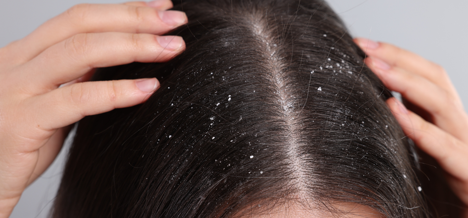 Dandruff