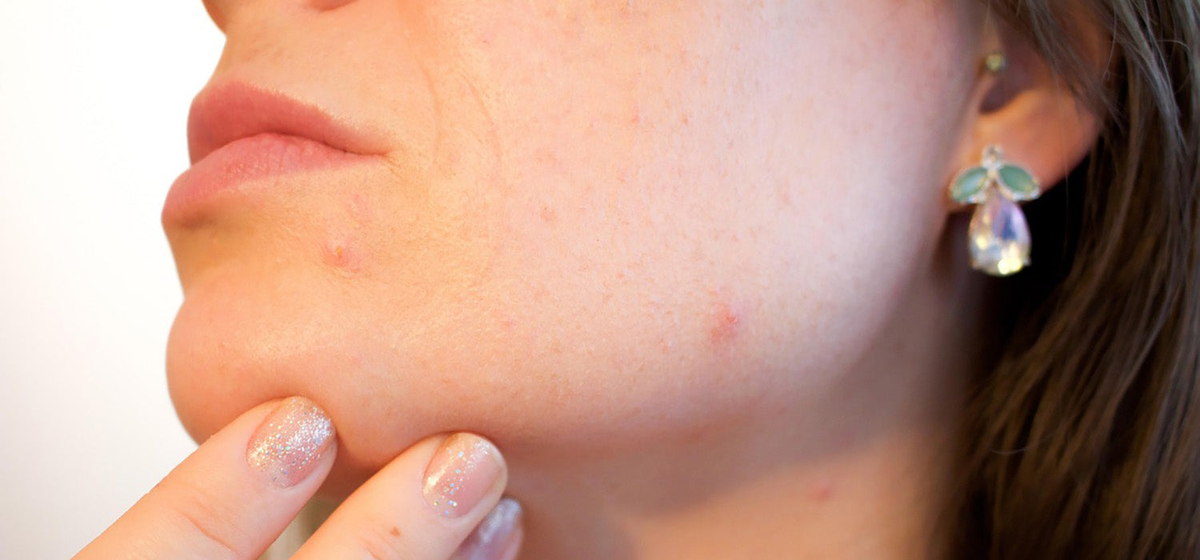 Acne Filter Effect Acne