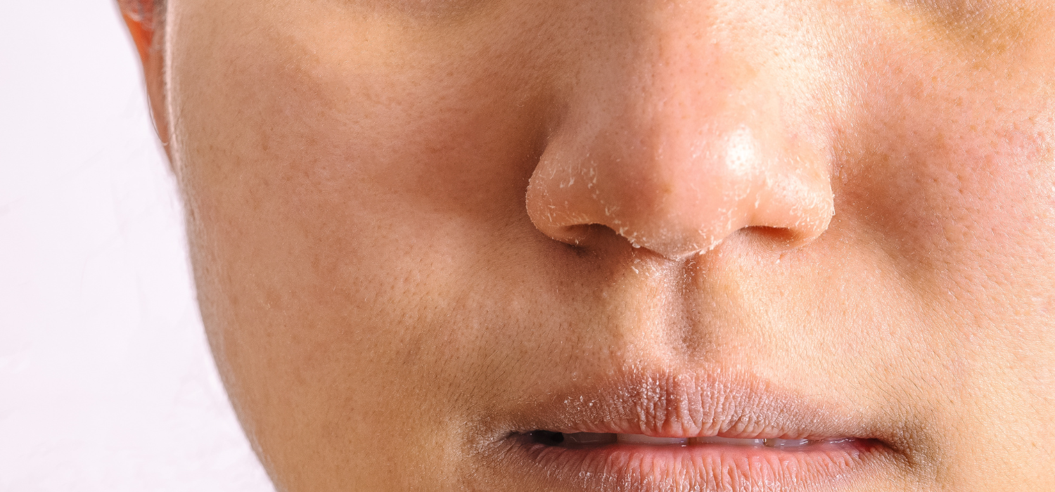 Dry Skin
